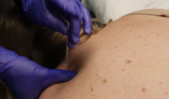 A photo of dry needling therapy with a needle inserted into a patients shoulder
